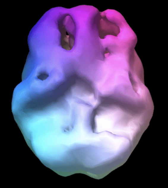 Brain Scans Post Traumatic Brain Injury - Front Range Family Resource ...